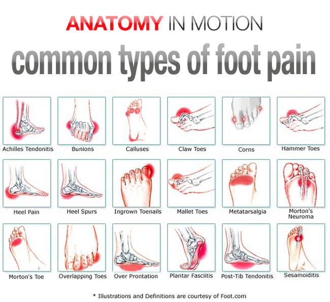 Bottom Of Foot Pain Diagram