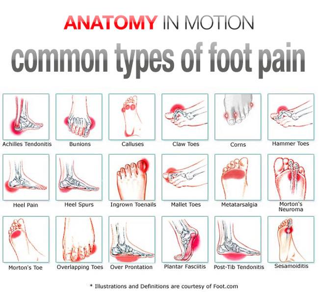 foot pain- A-I-M-photo