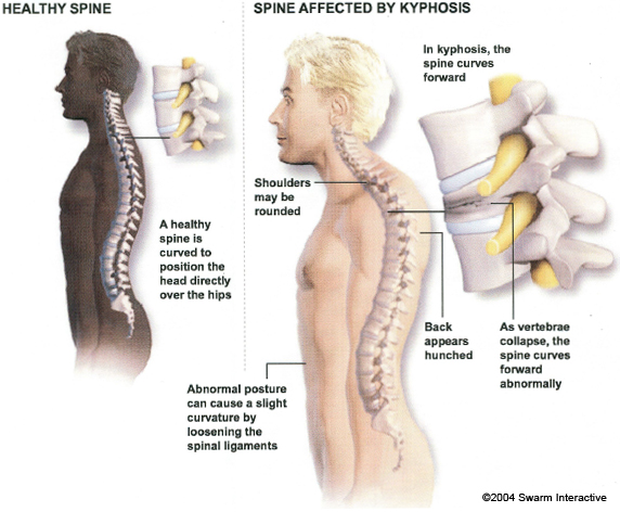 yogatherapy yoga shoulder pain relief